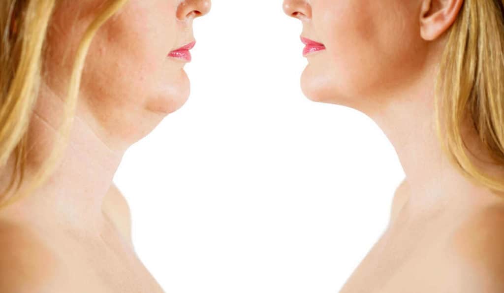 Double Chin treatment Bethnal Green before and after results