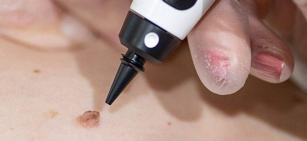 After Skin Tag Removal Bethnal Green