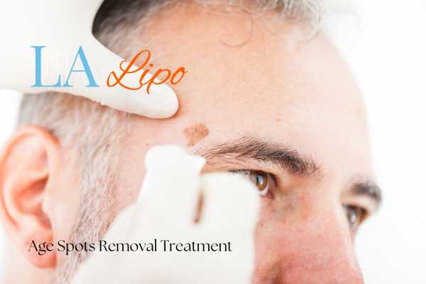 What Are the Most Effective Treatments for Age Spots Bethnal Green?