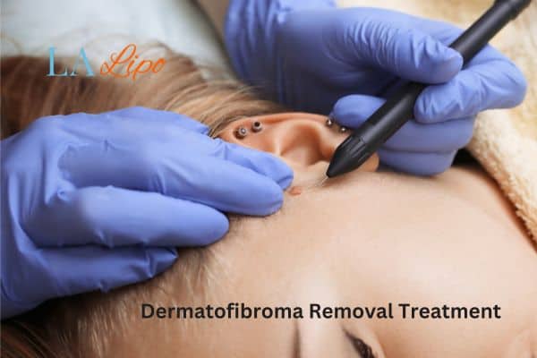 Dermatofibroma Removal Treatment Bethnal Green
