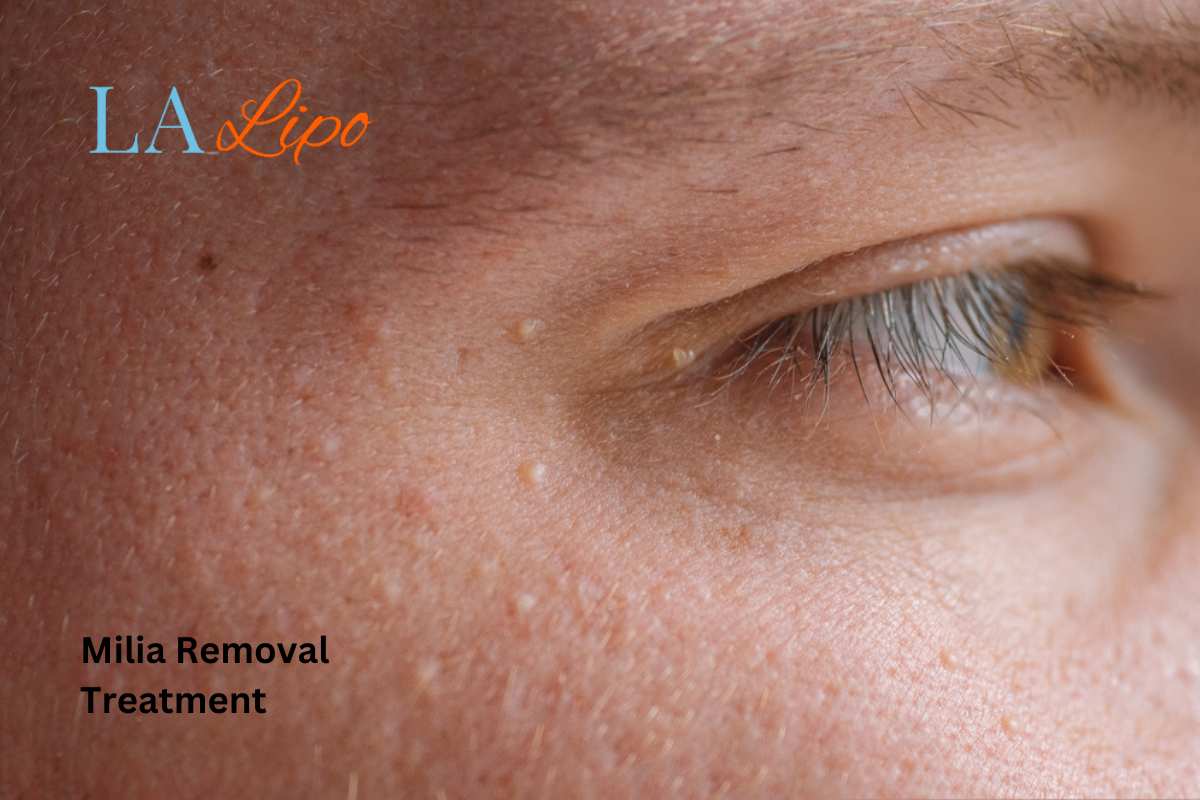Cryopen Milia Removal: Is It the Easiest and Safest Option Bethnal Green?