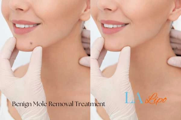 woman's before and after mole removal Bethnal Green results