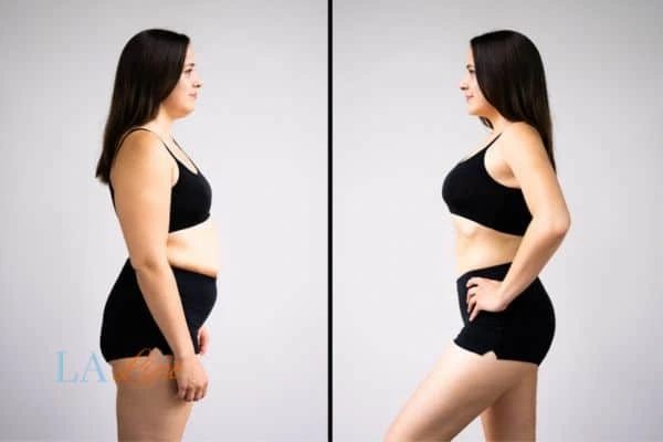 image of woman before and after results of LA-EMS Body Sculpting Bethnal Green to help treat Diastasis recti