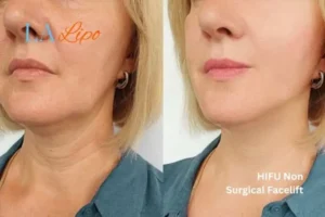hi-fu for wrinkles Bethnal Green before and after results