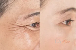 Before and after results of woman - HI-fu wrinkles reduction treatment Bethnal Green