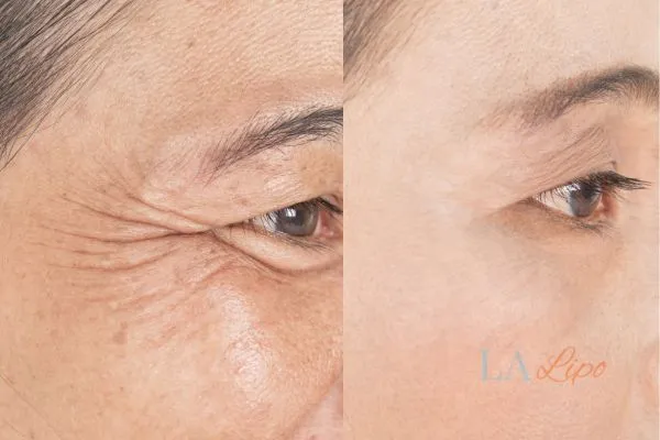 Before and after results of woman - HI-fu wrinkles reduction treatment Bethnal Green