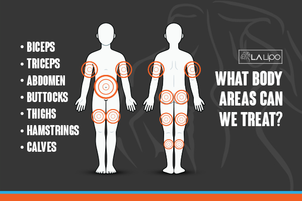 Graphic to show areas you can have LA-EMS Body Sculpting Bethnal Green treatment.