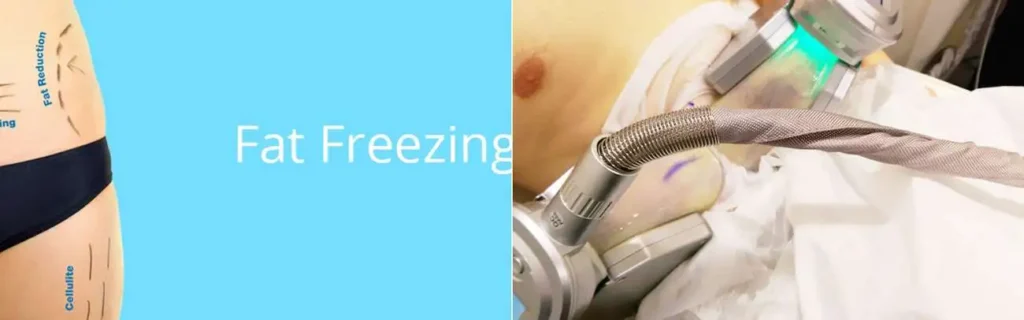Fat freezing Bethnal Green on multiple areas of the body