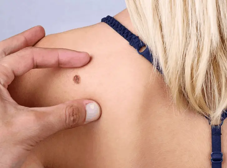woman having mole removal Bethnal Green consultation before treatment.
