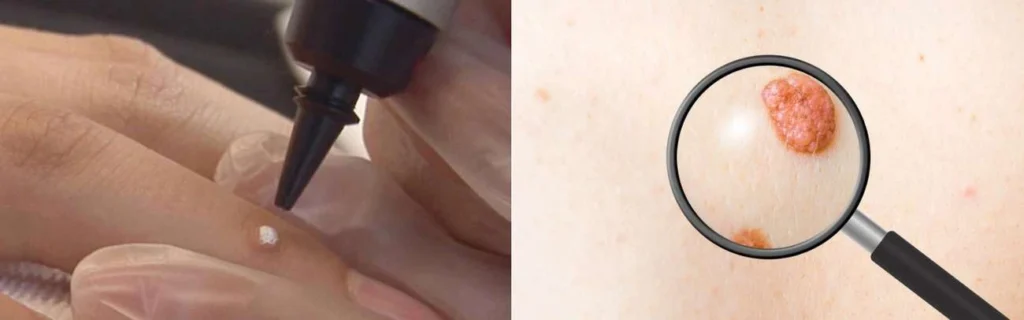 CryoPen practitioner Bethnal Green assessing a benign mole before treatment