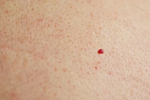 close up of a cherry angioma Bethnal Green