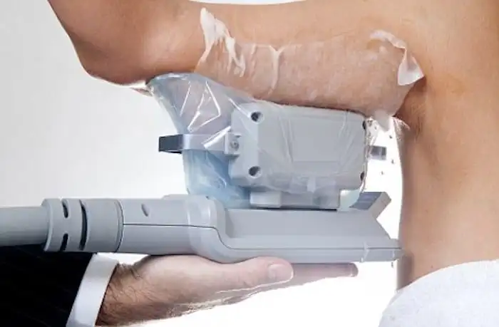 Picture of fat freezing Bethnal Green on the upper arms.
