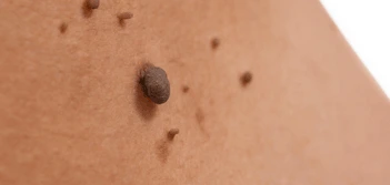 image of a skin tag Bethnal Green
