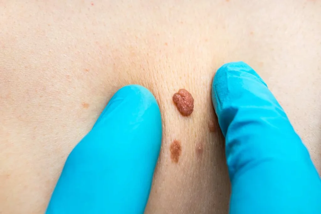Consultant examining a skin tag Bethnal Green