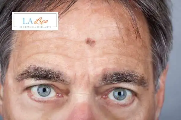 Solar Lentigo Removal Bethnal Green image of man with mark on his forehead