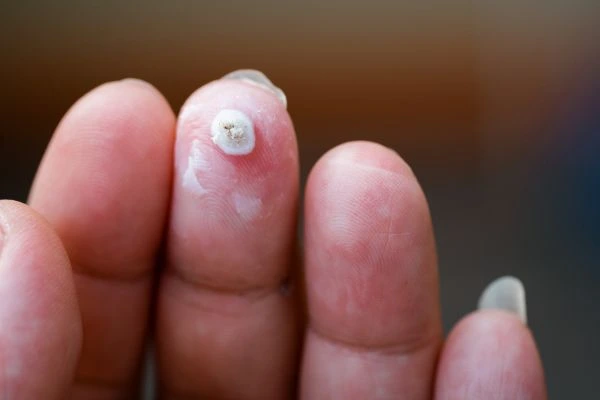 wart on person finger - cryotherapy to treat from LA LIPO Bethnal Green