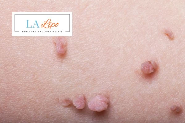Does cryopen skin tag removal Bethnal Green hurt? Find out now call our team today!