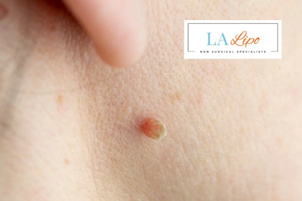 Book skin tag removal Bethnal Green today speak to our team now!