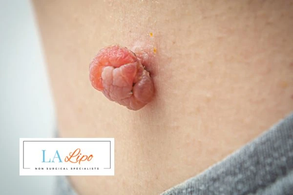 Interested in skin tag removal Bethnal Green? Concerned about the pain? Find out more today!