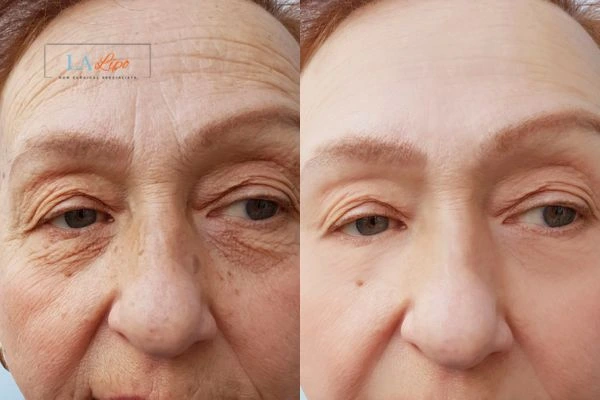 The powerful benefits of Morpheus8 Treatment Bethnal Green - Call Our team today!