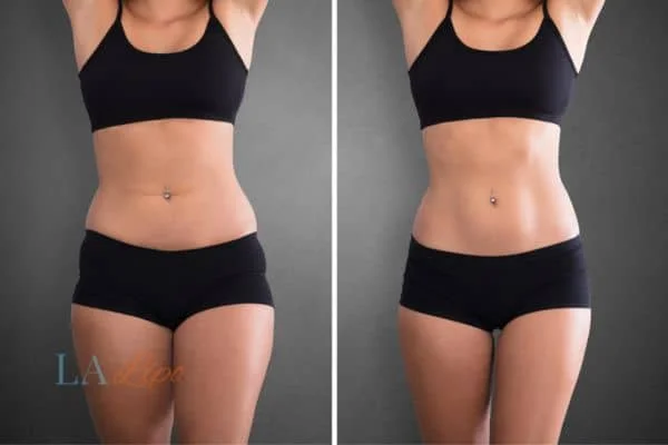 before and after results of non-surgical treatment to help a woman's body image and mental health Bethnal Green