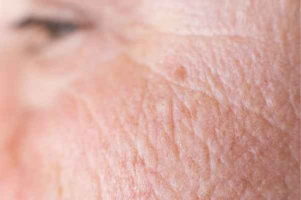 close up picture of a woman's face showing an age spot Bethnal Green