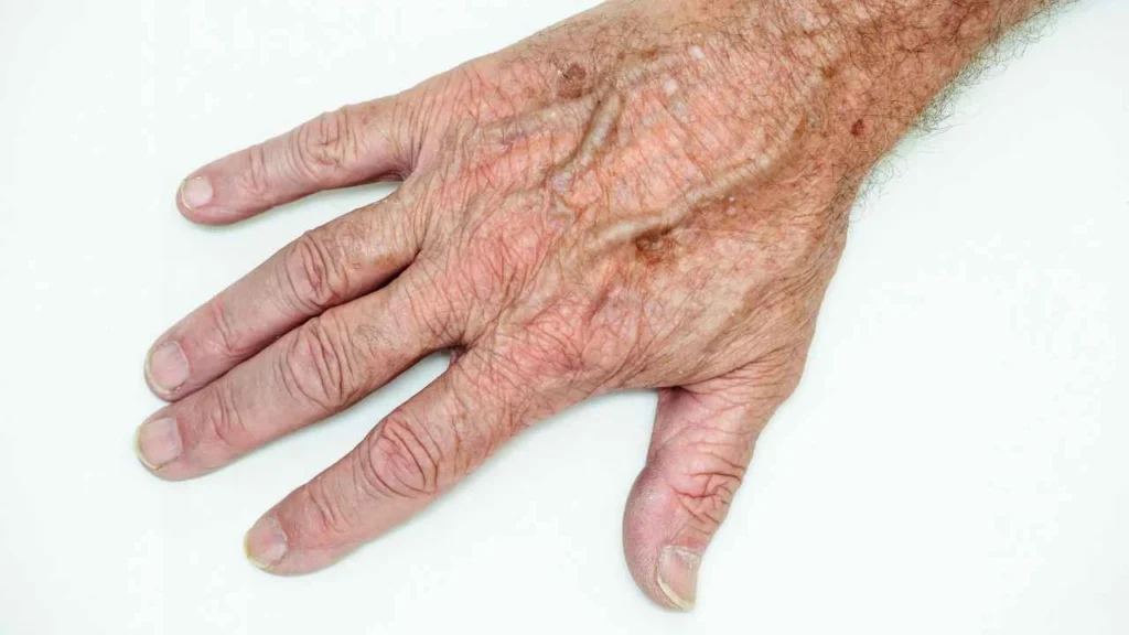 Male hand showing age spot Bethnal Green