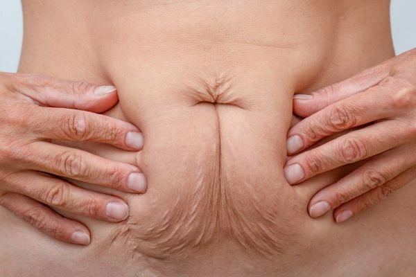 Image of a woman's stomach with loose skin - example of skin tightening Bethnal Green options