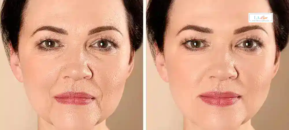 How Long Does It Take to See Results and How Long Do They Last Bethnal Green?