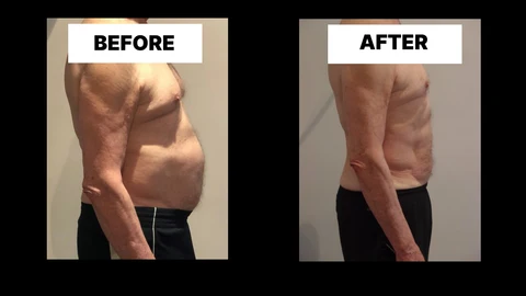 What Symptoms Can Diastasis Recti Cause in Men? Weak Core, Back Pain and Poor Posture Bethnal Green